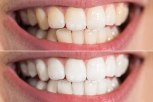 Before And After Whitening