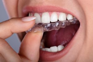 Clear aligner brace