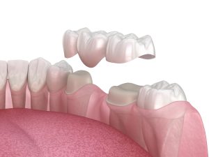Teeth prepped for a 3 unit bridge