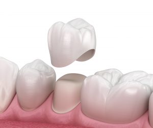 Tooth prepped for a crown