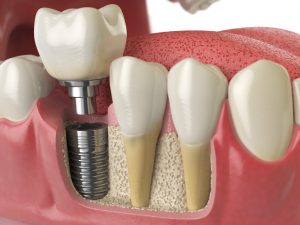 Implant retained crown
